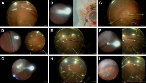 Figure 2 Intraoperative 2D snapshots in a case of hybrid surgery for rhegmatogenous retinal detachment. (A) Core vitrectomy performed using a wide-angle view (WAV). (B) Cryopexy to fix a tiny retinal break identified intraoperatively at the ora serrata using the endoscopic view (left). A microscopic view of the outer segment is simultaneously visualized (right) and helps to prevent freezing of the cornea or the lid. (C) Injection of perfluorocarbon liquid (PFCL) while using WAV. (D) Peripheral vitreous shaving performed while using the endoscopic view without any scleral depression. (E) Fluid/air exchange and removal of PFCL using WAV. (F) Internal drainage through an original retinal break at the periphery. The images from both the endoscopic view (left) and WAV (right) are integrated on the same monitor. (G) Endoscopic view of the internal drainage. (H) PFCL is completely removed while using WAV. (I) Laser photocoagulation of a retinal break while using the magnified endoscopic view (left). Simultaneous visualization by WAV (right) helps with the orientation of the endoscopic manipulation.