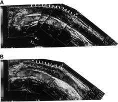 Figure 1. (A) A 37-year-old male patient received color flow Doppler ultrasound showing the presence of long segmental thrombus (arrowheads) in the basilic vein without detection of blood flow. (B) After manual declotting, blood flow reappeared in the basilic vein (arrows) unmasked the underlying stenosis.