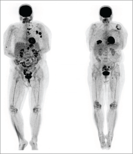 Figure 3. Patient 2. PET/CT on 3/13 (left, prior to vemurafenib) showed intensely FDG avid lymph nodes and soft tissue deposits post ipilimumab. PET/CT on 6/13 (right, after vemurafenib) showed the previously described intensely FDG avid lymph nodes and nodules had entirely resolved. The vemurafenib was gradually weaned and stopped by 3/14. She has remained in complete remission to date off therapy.