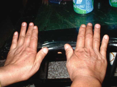 Fig. 2.  Photograph displaying the fingernails of the 48-year-old female patient. This photograph was taken approximately seven years after her Bajiaolian poisoning. Comparison with Fig. 1 does not reveal any discernable change in fingernail length. The nails had not been cut in the period between the two photographs.