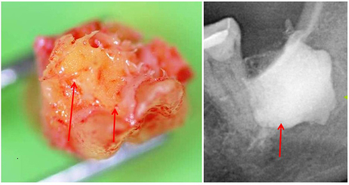 Figure 1 Hollow cavitations with fatty degenerated adipocytes have undergone dystrophic changes. All 32 BMDJ/FDOJ samples presented themselves clinically and macroscopically as fatty lumps. Shows a type of specimen with predominantly fatty transformation of the jawbone in the left part. The often impressive extent of BMDJ/FDOJ lesions is documented in the right part by X-ray with contrast medium. Legend left window: Red arrows show fatty-degenerative medullary spongial bone; necrotic adipocytes form yellow osteolytic and softened tissue. Legend left window: Red arrow shows contrast medium.