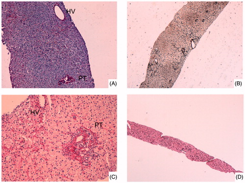 Figure 2. A - Case #1: Portal tracts (PT) and hepatic vein (HV) were normally organized. Atrophic hepatic plates alternated with thickened plates (Picro-hemalun stain, original magnification × 100). B - Case #1: Reticulin stain showed parenchyma nodular transformation (Gordon Sweet reticulin stain, original magnification × 40). C - Case #2: Portal tracts (PT) and hepatic vein (HV) were normally organized. There is congestion with perisinusoidal fibrosis in centrolobular areas (Picro-hemalun stain, original magnification × 100). D - Case #2: Reticulin stain did not showed nodular transformation of liver parenchyma (Gordon Sweet reticulin stain, original magnification × 10).