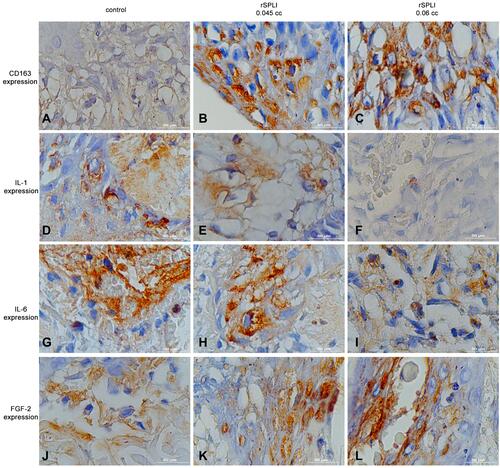 Figure 2 The cytokine expression in the skin wound. (A–C) IL-6 expression; (D–F) FGF-2 expression; (G–I) CD163 expression; (J–L) IL-1 expression. Microscopic feature with magnification 1000x.