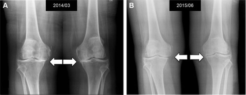 Figure 2 Standard weight-bearing knee X-rays of a 69-year-old female before (A) and 15 months after (B) one course of intra-articular PRP in association with HA injection, showing significant improvement in the narrowing joint space (white arrows).