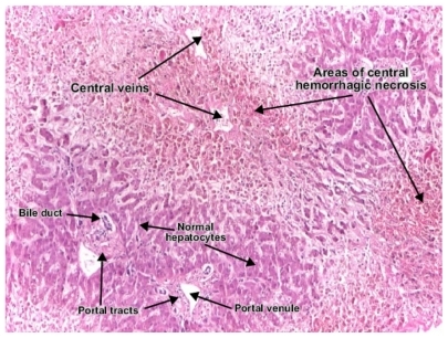 Figure 1 Case 1: areas of hemorrhagic necrosis and steatosis.