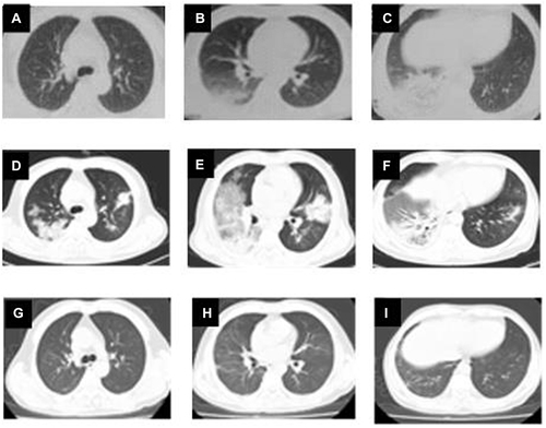 Figure 1 Chest CT of case 1 at the time of onset (A–C); 3 days after moxifloxacin treatment (D–F); 21 days after anti-psittacosis treatment (G–I).