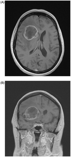 Figure 1. Contrast-enhanced axial T1 MR image (A) and matching coronal T1 image (B) illustrating a right frontal glioblastoma with SVZ contact.