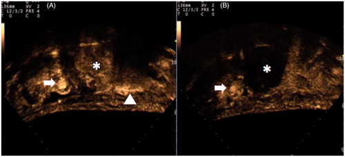 Figure 2. CEUS imaging before (A) and after (B) USgHIFU of 48 mm highly perfused uterine fibroma (*). In (B) CEUS shows a complete devascularisation of the treated fibroma. Arrow = left common femoral vein; arrowhead = bowel loop.