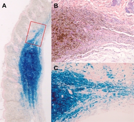 Figure 5 Histological aspect of superparamagnetic iron oxide nanoparticle-albumin complex in situ six months after implantation and heating procedure. (A) At scanning magnification of Prussian Blue-stained section, centrifugal fading rather than sharp circumscription of implant contours is seen (especially as opposed to Figure 7A). (B) and (C) represent consecutive section planes of boxed area in (A) to indicate gradual dissolution of implant iron content by macrophages. In parallel, there is fibroblastic ingrowth. Note absence of significant foreign body reaction. (A) and (C) Prussian Blue staining, (B) hematoxylin and eosin staining; original magnifications (A) 15× and (B) and (C) 200×.