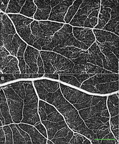 Figure S6 Peripheral noninvasive capillary-perfusion maps. Images from healthy subjects showing the peripheral retinal capillaries in great detail.