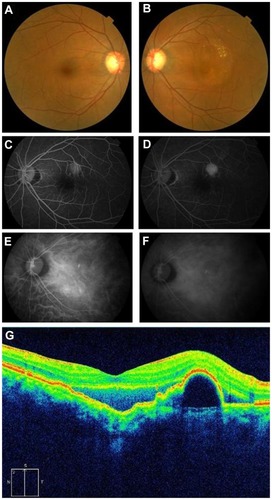 Figure 1 (A and B) show color fundus photographs of the right and left eyes, respectively. The left eye shows serous retinal detachment and exudates. (C and D) show the results of FA (early and late phase, respectively) and show hyperfluorescence (window defect) at the lesion of the PED. (E and F) show the results of IA (early and late phase, respectively) and show polypoidal fluorescence at the yellowish protruding lesion. SD-OCT demonstrates the separation of the retina between the inner segment and the outer segment junctions of the photoreceptor (IS/OS) line and the RPE with choroidal excavation (G).