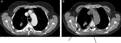 Figure 3.  Patient 3. A. Pulmonary metastasis in left lung and limited thickness of the pleura of the left lung. B. Increased pleural metastases in left lung.