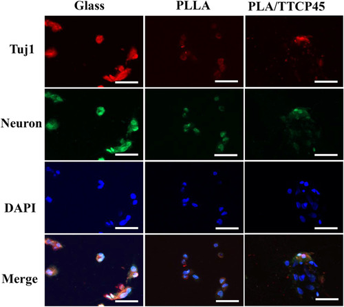 Figure 8 Differentiation of MSCs on nanofiber membranes. Immunostaining of neuron (green), tuj1 (red) and DAPI (blue) of MSCs cultured on day 9. Scale bars represent 40 μm.