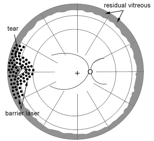 Figure 1 Diagram showing modified barrier laser around the retinal break and fortified along the vitreous base.