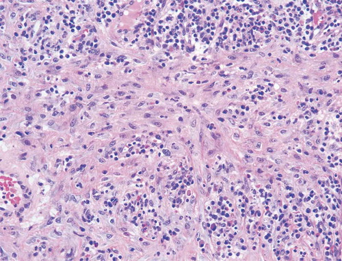 Picture 8. Areas of reactive fibrosis with plasma cell rich inflammatory infiltrate