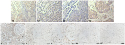 Figure 1 The expression of TLR9 and RUNX3 in lung cancer tissues (immunohistochemical SP method). Expression of TLR9 in tumor tissues (T1-T4) and RUNX3 in adjacent to cancer (R1-R5) was examined with DAB magnification 400Ẋ. Compared with normal bronchoalveolar cells, tumor cells became larger in volume and abnormally clumped together. TLR9 protein stained yellow or brown distributed equality in cytoplasm of tumor cells with unusual karyomegaly, multileaf nuclear and nuclear membrane thickened, etc. RUNX3 protein stained yellow or brown granular distributed in nucleus.