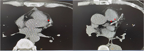 Figure 2 Identification of coronary artery calcifications (red arrows) in patients with type 2 diabetes. The coronary calcium score of left was 64 (with non-visceral obesity) while the right was 302 (with visceral obesity).
