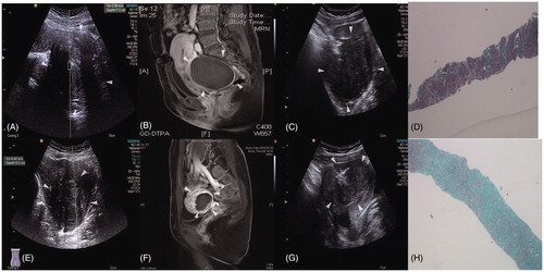 Figure 3. The SWV values, enhanced MRIs of postoperative uterine fibroids, and images of tissues at low power (4 × 10). (A) Preoperative fibroids with SWV values of 2.89 m/s and an ablation rate of ≥70%. (B) Enhanced MRI showing no residual mass. (C) Preoperative biopsy images of uterine fibroids. (D) Fibroid tissue at low power (4 × 10) and an ablation rate of ≥70%. (E) Preoperative fibroids with a SWV value of 4.62 m/s and an ablation rate of <70%. (F) Enhanced MRI showing residual mass with an ablation rate of <70%. (G) Preoperative biopsy images of the uterine fibroids. (H) Fibroid tissue at low power (4 × 10) and an ablation rate of <70%.