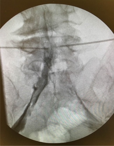 Figure 2 Anteroposterior fluoroscopic image of contrast injected through the second epidural catheter which was placed on the left side of the epidural space showing spread only to the left-sided nerve roots.