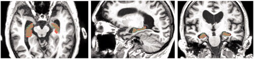 Figure 10. Data checking of overlap between Segmentation paint effect tool (brown) and Segmentation Editor (dim green). This figure shows the enlarged overlapping regions in the horizontal, sagittal, and coronal crosscut.