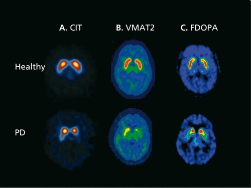 Figure 1. Representative radiotracer images of Parkinson's disease (PD) patients and healthy subjects. A. Single photon emission computed tomography (SPECT) images of dopamine transmitter (DAT) using [123I]β-CIT(2β-carbomethoxy-3β-(4-[123l]iodophenyl)tropane). B. Positron emission tomography (PET) images of DA synthesis with 18F]fluorodopa (FDOPA). C. PET images of vesicular monoamine transporter, type 2 (VMAT2) with [11C]dihydrotetrabenazine. These images were acquired in PD patients with relatively early onset of disease and compared to age-matched healthy subjects. The color scale is slightly different for the three radioligands. Nevertheless, all three imaging agents show a dramatic and similar loss (~50%) of striatal uptake in PD patients compared to the healthy subjects.A is from John Seibyl, MD (Institute for Neurodegenerative Disorders, New Haven, CT).B is from David Eidelberg, MD (North Shore-Long Island Jewish Research Institute, Manhasset, NY).C is from Kirk Frey, MD, PhD (University of Michigan at Ann Arbor, Ann Arbor, Mich).