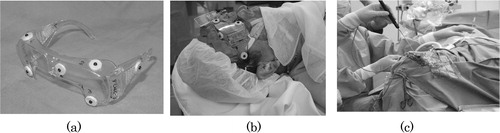 Figure 5. This set of figures displays the registration equipment and procedures. (a) The reference registration frame with markers visible in CT/MR images, (b) the patient wearing the reference registration frame with silicon rubber and (c) a surgeon registering the position of markers just before surgery by stylus probe with LEDs in order to align the patient's head and CT/MRI slices.