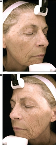 Figure 6 Photographs of the subject number 1 (female) who had spent more than half of her life working as a medical saleswoman and driving a car 2–5 hours per day. A) Nonwindow-exposed side (her right side). B) Window-exposed side (her left side): wrinkles of cheek, crow’s feet and wrinkles under the eyes are more numerous and deeper.