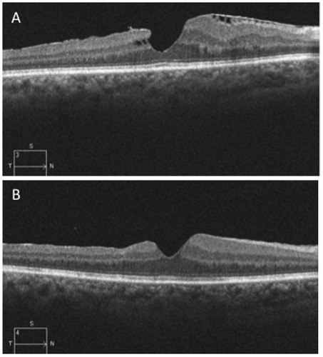 Figure 1 The preoperative OCT scan showed a tractional epiretinal membrane with intraretinal cysts.