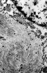 Fig. 3 Electron micrograph of tumor cell showing prominent paranuclear aggregate of intermediate filaments (*). n, nucleus, × 12,800.