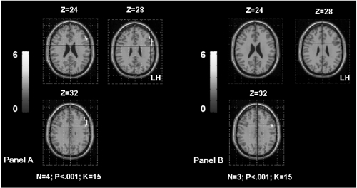 Figure 5 Shows the inferior frontal gyrus (IFG) activation in TLE patients according to the age of seizures onset. The Panel A shows left IFG activation in patients with seizures starting before age of 6 years old (OC, SDi, PD, CG from Table 1). The Panel B shows left IFG activation in patients with seizures starting after age of 6 years old (MR, FD, SD from Table 1). The first sub-group had significantly higher activation of the left frontal region than the second sub-group. The activation is projected onto 2D anatomical slices (left is right).