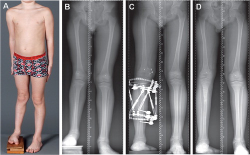 Figure 4. An 11-year-old boy with congenital femoral deficiency and fibular hemimelia (A). Long standing radiographs showed shortening in the femur and tibia, and valgus deformity caused by a dysplastic lateral femoral condyle (B). Since most of the shortening was below the knee, we started reconstruction by lengthening of the tibia and hemi-epiphysiodesis of the femur (C). Panel D was taken 6 months after frame removal. Femoral lengthening will be necessary in the future.