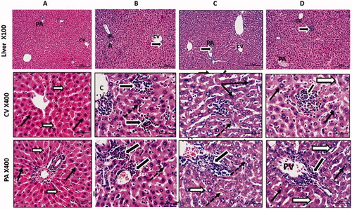 Figure 7. Anti-tumour activity of curcumin nanoparticles in mice engrafted Ehrlich solid carcinoma. Histological sections from liver stained with H&E and photographed at 100 with scale bar 200 µm and and 400X with scale bar 50 µm. Control group (A) shows normal central vein (CV) and portal vein (PV) regions with normal hepatocytes having rounded vesicular nuclei (black arrows) and separated by thin blood sinusoids (white arrows). Solid Ehrlich tumour group (B) shows a dilation of liver vessels (CV& PV), marked infiltration of hepatic sinusoids with malignant Ehrlich cells (thick black arrows), and hepatocytes showed large nuclei (dotted arrow). Solid Ehrlich tumour + Cis group (C) shows degenerated neoplastic cells with dark nuclei (thick black arrows). Hepatocytes showed large size nuclei or karyomegaly (dotted thin arrows). Others looked shrined with small dark degenerated nuclei (thin black arrow). Blood sinusoids are dilated with few inflammatory cells (white arrows). Solid Ehrlich tumour + Cis + Cur-NPs group(D) shows nearly normal hepatocyte with normal size and nuclear appearance. Hepatic blood sinusoids looked normal and not dilated (white arrows). Tumor cells still showed degrative changes (thick black arrows).