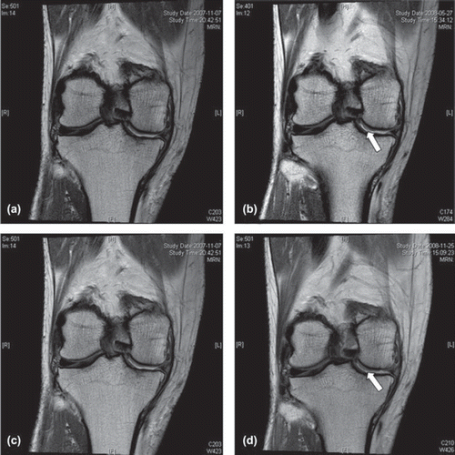 Figure 3. Proton-density coronal magnetic resonance image for patient 011 at baseline (a, c), 6 months (b) and 12 months (d). The appearance of cartilage regeneration is seen in (b) and (d), especially around the periphery of the grade 4 lesion site at the medial femoral condyle, as indicated with the arrow.