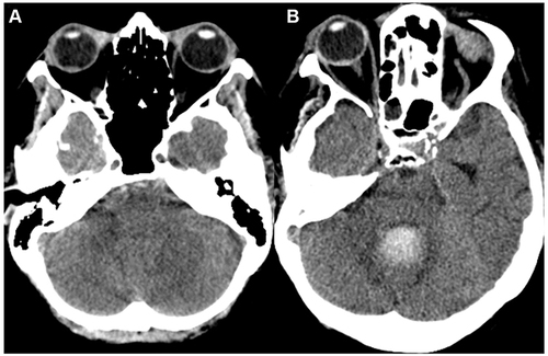 Figure 2 Head CT scan of patients 3 and 5 (Table 3) showing a positive crescent sign in both right eyes ((A and B), respectively). In the first case, the sign is present 1 day after the diagnosis of a subarachnoid haemorrhage due to an intradural dissection of the right vertebral artery, and 10 days before the ophthalmological diagnosis. In the second clinical picture, the sign is visible 11 days after the diagnosis of a subarachnoid haemorrhage due to the rupture of a right anterior cerebral artery aneurysm and 109 days before the diagnosis of Terson syndrome was made.
