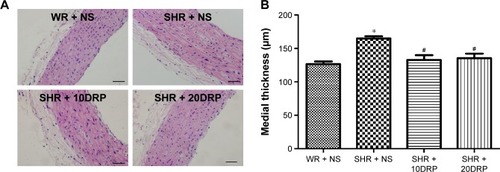 Figure 5 DRPs reduce aortic medial thickness in SHR.Notes: (A) Representative images of thoracic aorta with hematoxylin and eosin staining of each group. Scale bar: 50 μm. (B) Quantitative analysis of medial thickness (μm). Values are mean ± SEM, n=4 per group, *P<0.05 compared with WR + NS and #P<0.05 compared with SHR + NS.Abbreviations: DRP, drag-reducing polymer; SHR, spontaneously hypertensive rats; SEM, standard error of the mean; WR, Wistar rats; NS, normal saline.