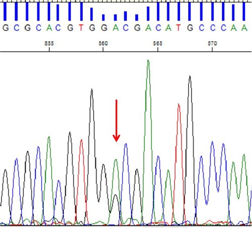 Figure 3. DNA sequencing analysis showing the mutation of HBA2: c.224A > G on the α2 gene. (arrow indicates heterozygous HBA2: c. 224A > G mutation).