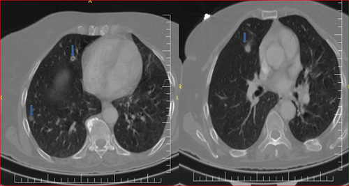 Figure 3 Axial chest CT shows several peripheral predominant nodules and some cavitation in both lungs (septic pulmonary embolism).