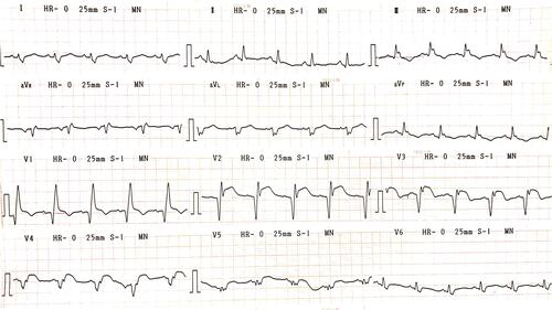 Figure 1 Electrocardiogram showed ST-segment elevation in anterior leads with right bundle-branch block pattern.