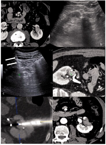 Figure 1. A case of a 52 y.o. patient with a single 12 mm RCC relapse after robotic assisted partial nephrectomy: (a) CT scan showing a 12 mm enhancing lesion in the left kidney. (b) US evaluation performed before treatment didn’t allow for clear identification of the tumor. (c) US/CT fusion imaging obtained during the treatment allowed to place a marker (green marker) on the tumor on the CT images to identify the target on US, and thus to provide guidance for needle insertion (white arrows). (d) CT scan performed immediately after needle insertion confirmed the correct targeting of the tumor (blue marker). (e) CT performed 24 h after the procedure showing a complete ablation.