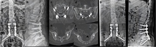 Figure 3 Immediate postoperative x-ray (a and b) and CT (c–f) showed that S1 CBT and S2 AI screws reached grade A according to the modified Gertzbein-Robbins classification. X-ray at 12 months after surgery (g–h).