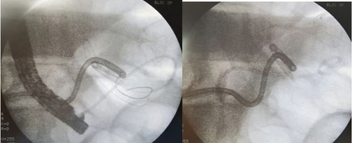 Figure 3. X-ray showing the endoscopic internal drainage with double pigtail plastic stent.