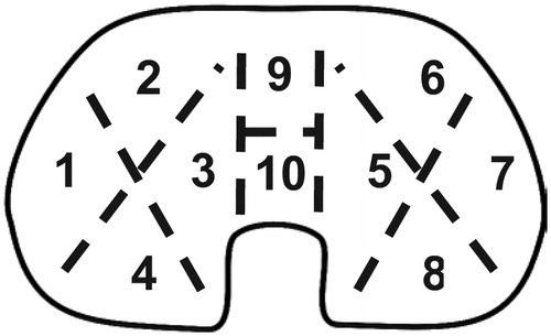 Figure 2. The articular and backside of the inlay was divided into sectors for wear evaluation according to the Hood scale.