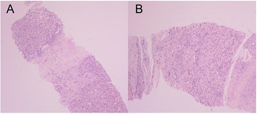 Figure 3 Pathological findings of liver mass in segment V. Hematoxylin and eosin (H&E) staining. Original magnification: (A)×40. (B) ×100.