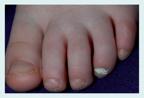 Figure 4. White superficial onychomycosis ‘deep’ caused by Trichophyton interdigitale in a 6-year-old boy: the nail plate is diffusely white and opaque due to massive fungal invasion.