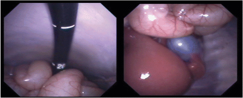 Figure 1. Endoscopic view of a transgastric procedure. [Color version available online.]