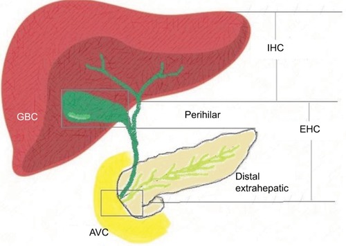 Figure 1 Anatomical sub-variants of BTC.Abbreviations: AVC, ampulla of Vater cancer; BTC, biliary tract cancer; EHC, extrahepatic cholangiocarcinoma; GBC, gallbladder cancer; IHC, intrahepatic cholangiocarcinoma.