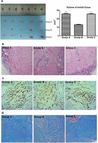 Figure 6. Treatment with the HIF-1α inhibitor suppressed the growth of keloid tissues in nude mice. The volume of keloid tissue in nude mice that had been treated with the HIF-1α inhibitor was significantly smaller than that in the control groups (a). Hematoxylin and eosin stain (a), immunohistochemistry staining (b) and Masson staining (c) of keloid tissues from nude mice. (*p < 0.05)