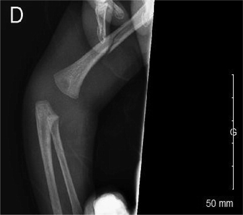 Figure 1. X-ray image of the trauma.