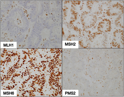 Figure 3 IHC of dMMR tumor deficient in MLH1 and PMS2. Photomicrographs show non-reactivity to MLH1 and PMS2 antibodies, faint nuclear staining with MSH2 antibodies, and intense staining with MSH6 antibodies (100X magnification).