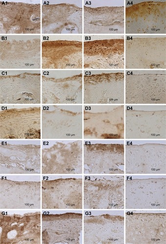 Figure 8 Immunohistochemical staining of the cartilage.Notes: (A) SIRT1 protein. (B) VEGF protein. (C) PTEN protein. (D) AKT protein. (E) Caspase 9 protein. (F) MMP13 protein. (G) Type II collagen protein. 1) The bioactive resveratrol–PLA–gelatin porous nano-scaffold group. 2) The blank porous PLA–gelatin nano-scaffold group. 3) The no scaffold group. 4) The sham group.